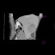 Hepatocellular carcinoma - 3 phase CT scans: CT - Computed tomography