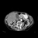 Hepatocellular carcinoma - 3 phase CT scans: CT - Computed tomography