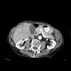 Hepatocellular carcinoma - 3 phase CT scans: CT - Computed tomography