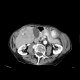 Hepatocellular carcinoma - 3 phase CT scans: CT - Computed tomography