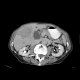 Hepatocellular carcinoma - 3 phase CT scans: CT - Computed tomography