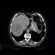 Hepatocellular carcinoma, HCC, gigantic: CT - Computed tomography