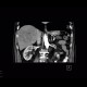 Hepatocellular carcinoma, HCC, gigantic: CT - Computed tomography