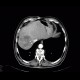 Hepatocellular carcinoma, HCC, gigantic: CT - Computed tomography