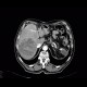 Hepatocellular carcinoma, HCC, gigantic: CT - Computed tomography