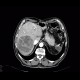 Hepatocellular carcinoma, HCC, gigantic: CT - Computed tomography