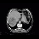 Hepatocellular carcinoma, HCC, gigantic: CT - Computed tomography