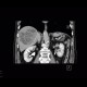 Hepatocellular carcinoma, HCC, gigantic: CT - Computed tomography
