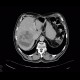 Hepatocellular carcinoma, HCC, gigantic: CT - Computed tomography