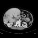 Hereditary hemochromatosis: CT - Computed tomography