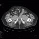 Scrotal hernia: CT - Computed tomography