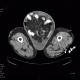 Scrotal hernia: CT - Computed tomography