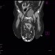 Scrotal hernia: CT - Computed tomography