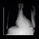 Hiatal hernia, chest radiograph: X-ray - Plain radiograph