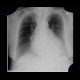 Hiatal hernia, chest radiograph: X-ray - Plain radiograph