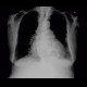 Hiatal hernia, chest radiograph: X-ray - Plain radiograph