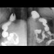 Hiatal hernia: RF - Fluoroscopy