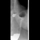 Hiatal hernia: RF - Fluoroscopy