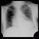 Hiatal hernia, chest radiograph, second patient: X-ray - Plain radiograph