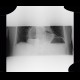 Hiatal hernia, gigantic: X-ray - Plain radiograph