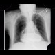Hiatal hernia, gigantic: X-ray - Plain radiograph