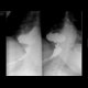 Hiatal hernia: RF - Fluoroscopy