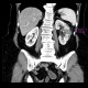 Subsegmental kidney infraction or focal nephritis: CT - Computed tomography