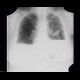 Hydropneumothorax: X-ray - Plain radiograph