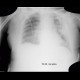 Hydropneumothorax: X-ray - Plain radiograph