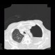 Hydropneumothorax: CT - Computed tomography