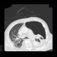 Hydropneumothorax: CT - Computed tomography