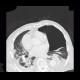 Hydropneumothorax: CT - Computed tomography