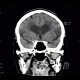 Leukoaraiosis, atherosclerotic encephalopathy, periventricular atrophy, hydrocephalus e vacuo: CT - Computed tomography