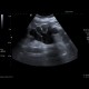 Hydronephrosis, end-stage: US - Ultrasound