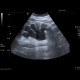 Hydronephrosis, end-stage: US - Ultrasound