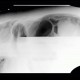 Hydropneumoperitoneum, pneumoperitoneum, ascites, Rigler's sign: X-ray - Plain radiograph