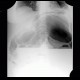 Hydropneumoperitoneum, pneumoperitoneum, ascites, Rigler's sign: X-ray - Plain radiograph