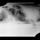 Hydropneumoperitoneum, pneumoperitoneum, ascites, Rigler's sign: X-ray - Plain radiograph