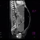 Hydropneumoperitoneum, pneumoperitoneum, ascites, Rigler's sign: CT - Computed tomography