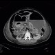 Hydropneumoperitoneum, pneumoperitoneum, ascites, Rigler's sign: CT - Computed tomography