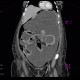 Hydropneumoperitoneum, pneumoperitoneum, ascites, Rigler's sign: CT - Computed tomography