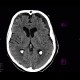 Hygroma: CT - Computed tomography