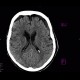 Hygroma: CT - Computed tomography