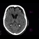 Hygroma: CT - Computed tomography