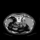 Liver metastasis of renal cell carcinoma, RFA: CT - Computed tomography