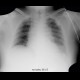 Hypoventilation, atelectasis of lower lung lobe: X-ray - Plain radiograph