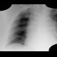 Hypoventilation, atelectasis of lower lung lobe: X-ray - Plain radiograph