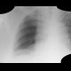 Hypoventilation, atelectasis of lower lung lobe: X-ray - Plain radiograph