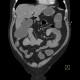 Ileocecal resection, postinflammatory changes of neoterminal ileum, CT enterography: CT - Computed tomography