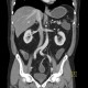 Ileocecal resection, postinflammatory changes of neoterminal ileum, CT enterography: CT - Computed tomography